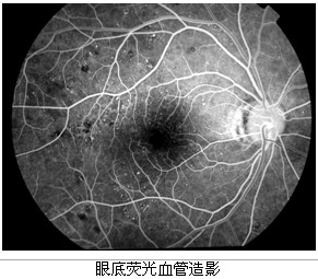 2,另一项很重要的检查是眼底荧光血管造影:对达到或超过中度非增生性